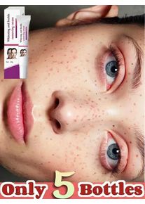 Remove Dark Spots Whitening Freckle Cream Effective Remove Melasma Melanin Moisturize Brighten Smooth Face Cream Skin Care