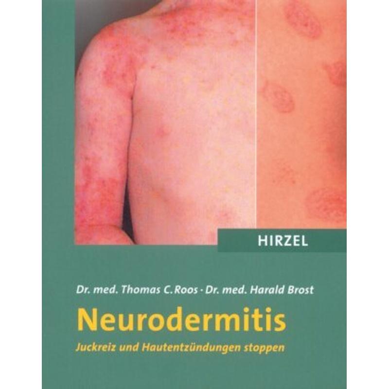 Neurodermitis - Thomas C. Roos, Harald Brost, Kartoniert (TB)